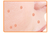 Does Red Clover Cure Acne?