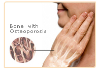 non estrogen osteoporosis
