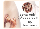 soy osteoporosis
