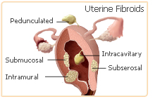 vitex-fibroids